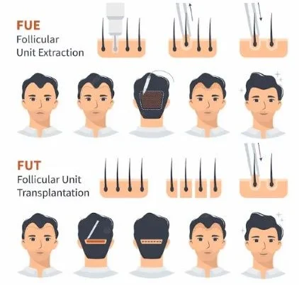 hair transplant types